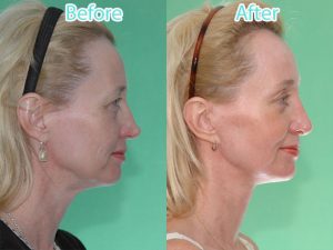 Gallery - Top Plastic Surgeon In McLean, VA