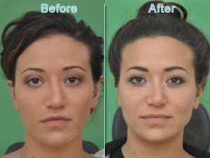 Gallery - Top Plastic Surgeon In McLean, VA