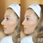 Nose Job Before and Afters Near McLean VA