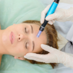 Microneedling Cost in Tysons Corner