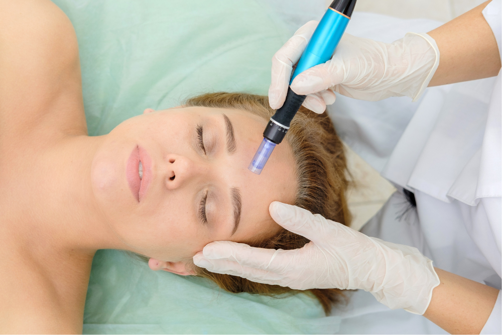 Microneedling Cost in Tysons Corner