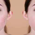 Same-Day Acne Scar Treatment in Tysons Corner