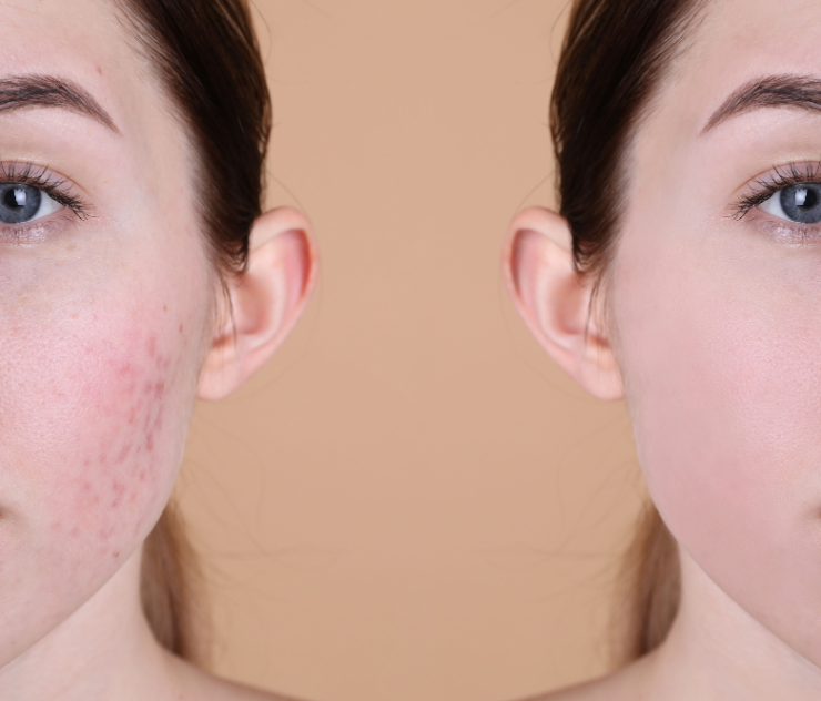 Same-Day Acne Scar Treatment in Tysons Corner