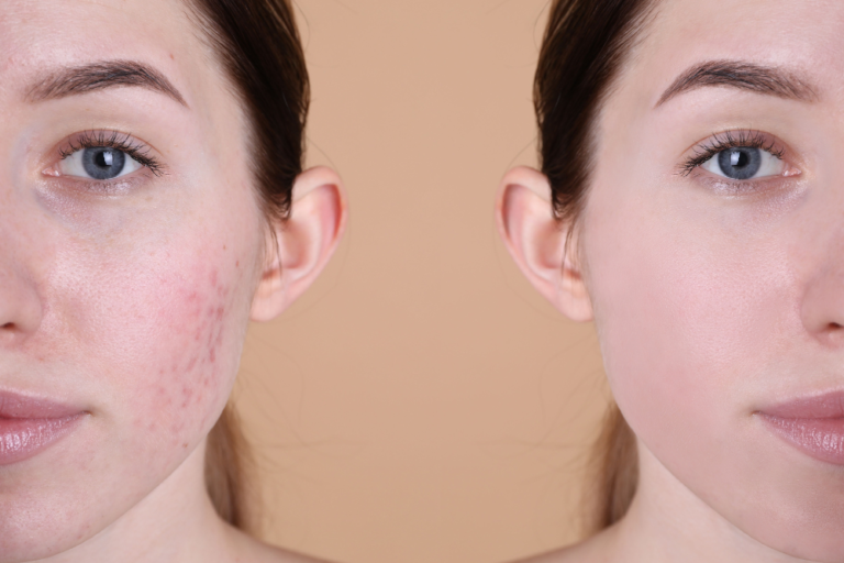 Same-Day Acne Scar Treatment in Tysons Corner