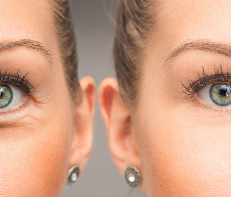 Top Surgeons in McLean Specializing in Eyelid Surgery