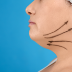 Choosing the Top Neck Lift Surgery Specialists in Ashburn, VA